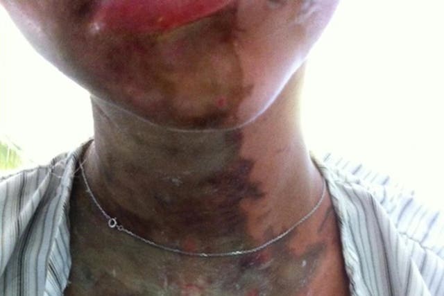 Family handout photo of one of the two British teenagers attacked with acid on Zanzibar.