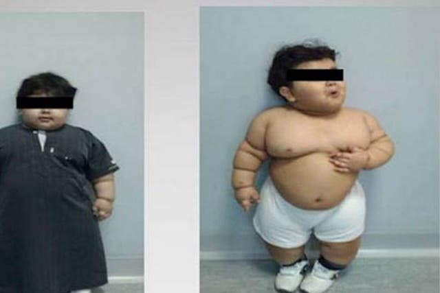 The child had a Body Mass Index of 41 had continued to gain weight despite efforts to control his diet. 