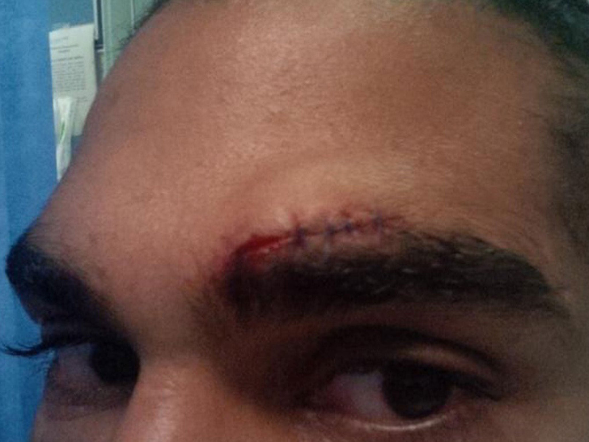 Sight for sore eyes: David Haye shows off his stitches yesterday