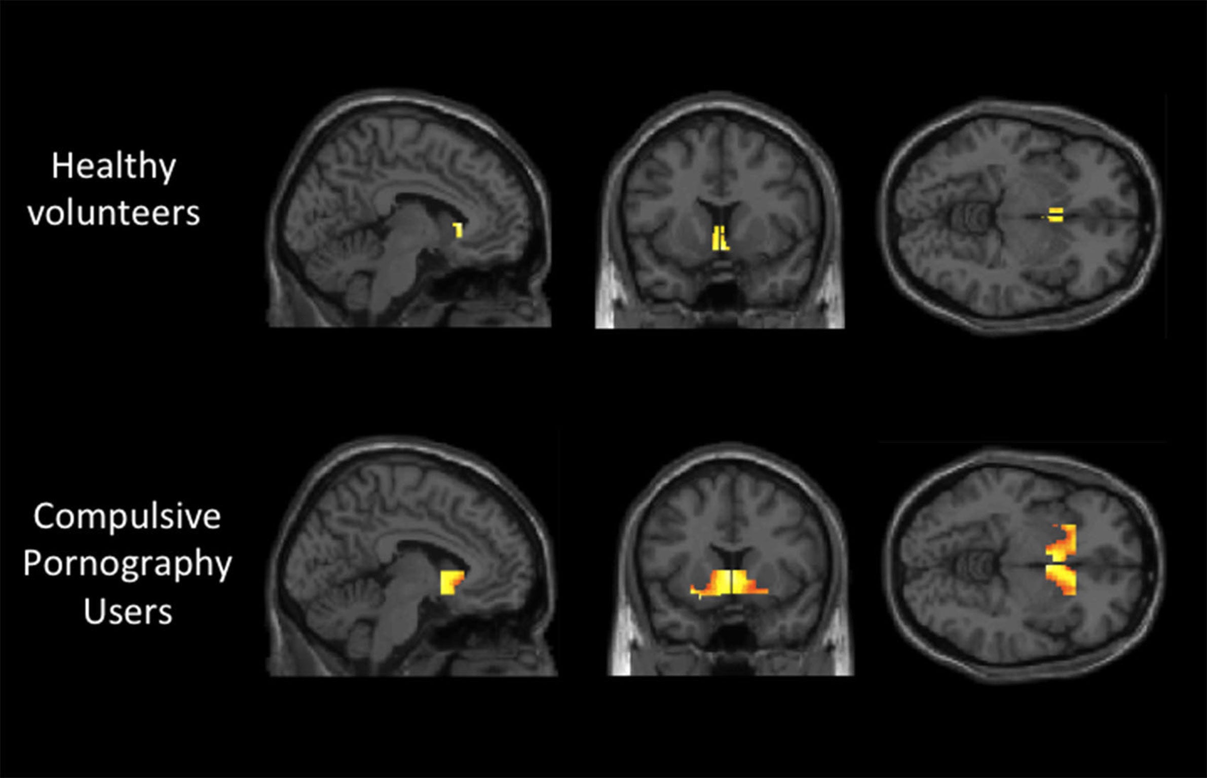 A study from Cambridge University has found that the brains of compulsive pornography users react in a similar way to stimulus as alcoholics or drug addicts