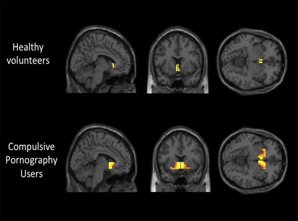Pornography addiction leads to same brain activity as alcoholism or ... picture image