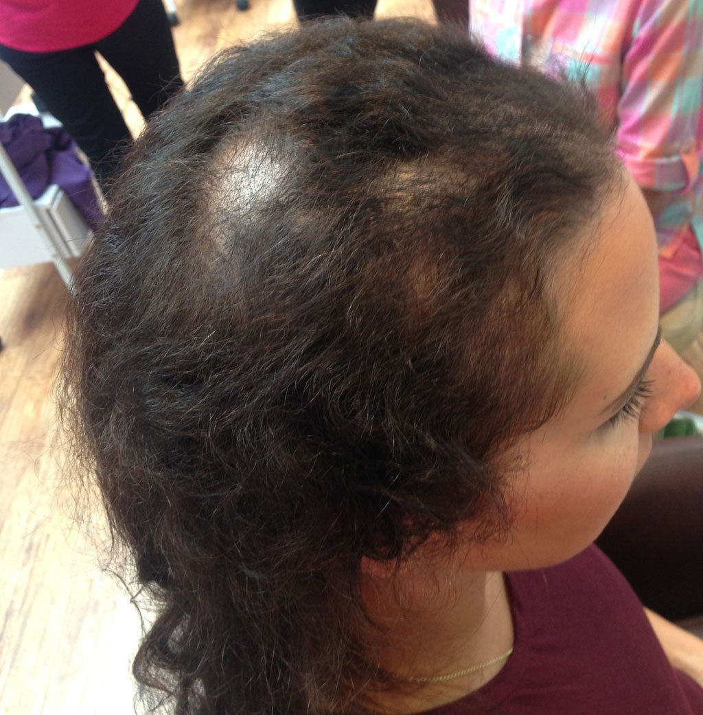 Pulling Your Hair Out Life With Trichotillomania The Independent