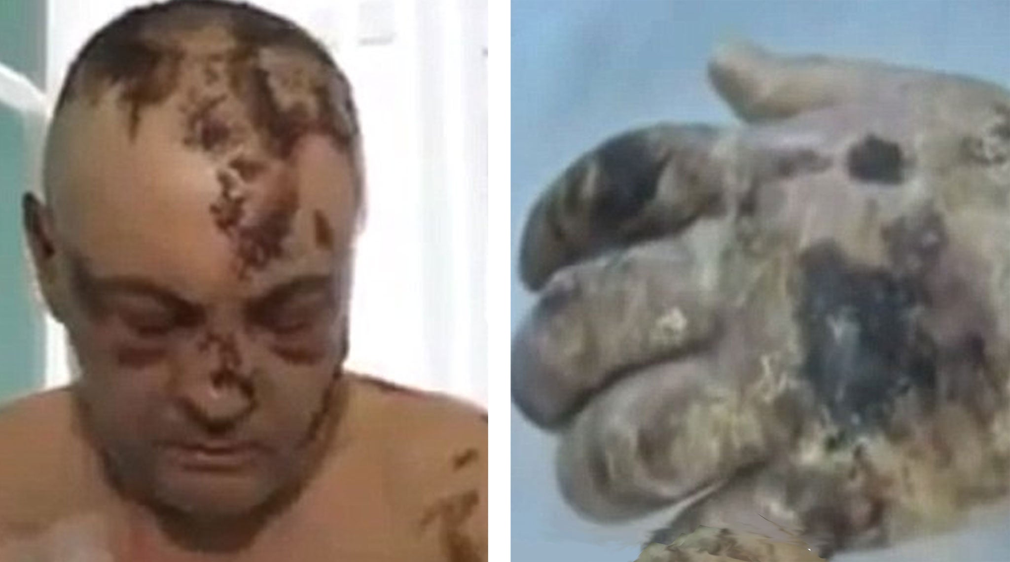 Krokodil Skin, Effects Causes and Treatments - Pictures