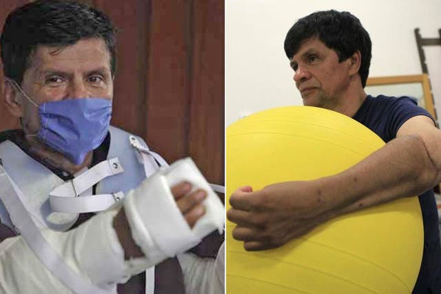 Gabriel Granados after the 17-hour surgery, left, and recovered during physiotherapy