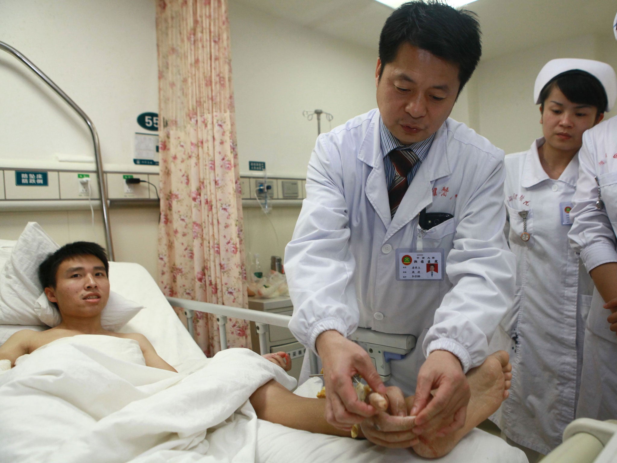 Doctors kept the hand alive by attaching it to Mr Xiao's ankle