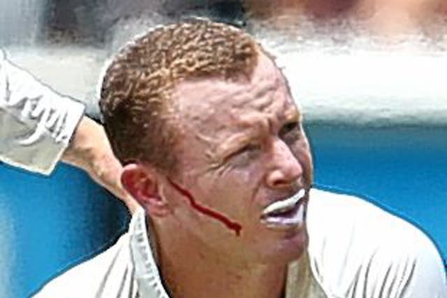 Chris Rogers is left bleeding after being hit by a Stuart Broad delivery