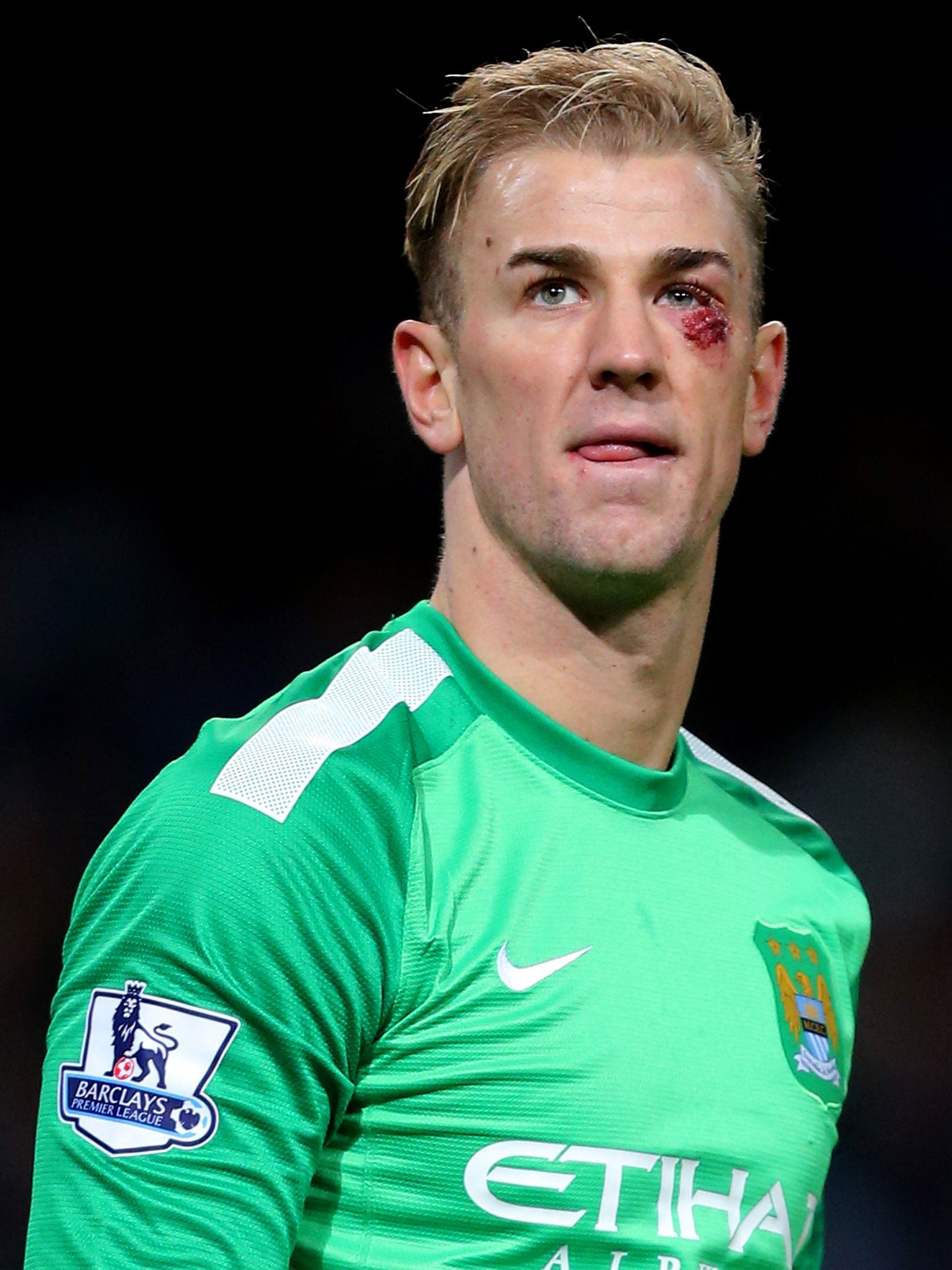 Joe Hart needed six stitches in an eye wound on Saturday