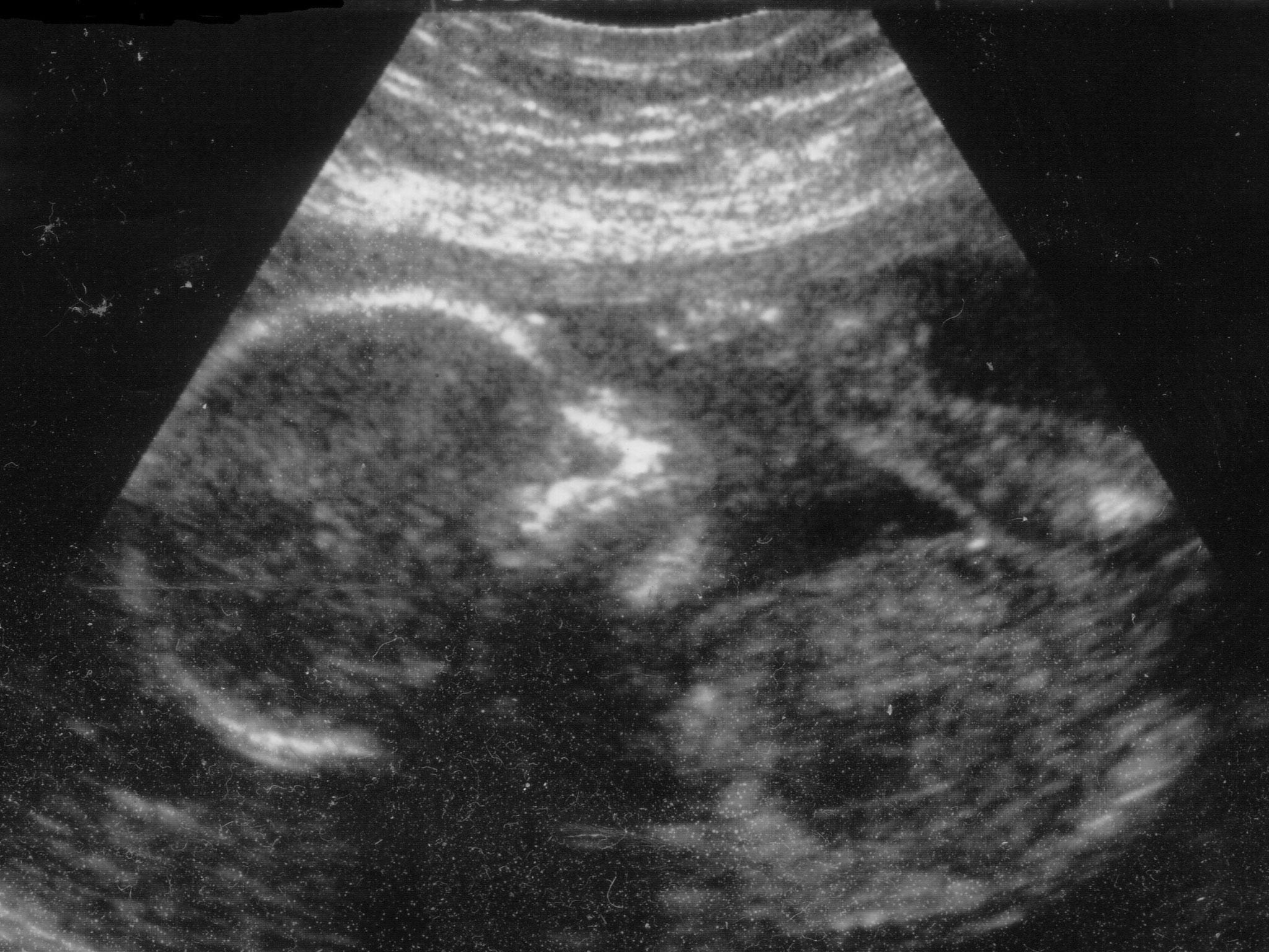 Pressure is growing for the Government to change the way that ultrasound scans can be used to inform pregnant women about the gender of their unborn babies