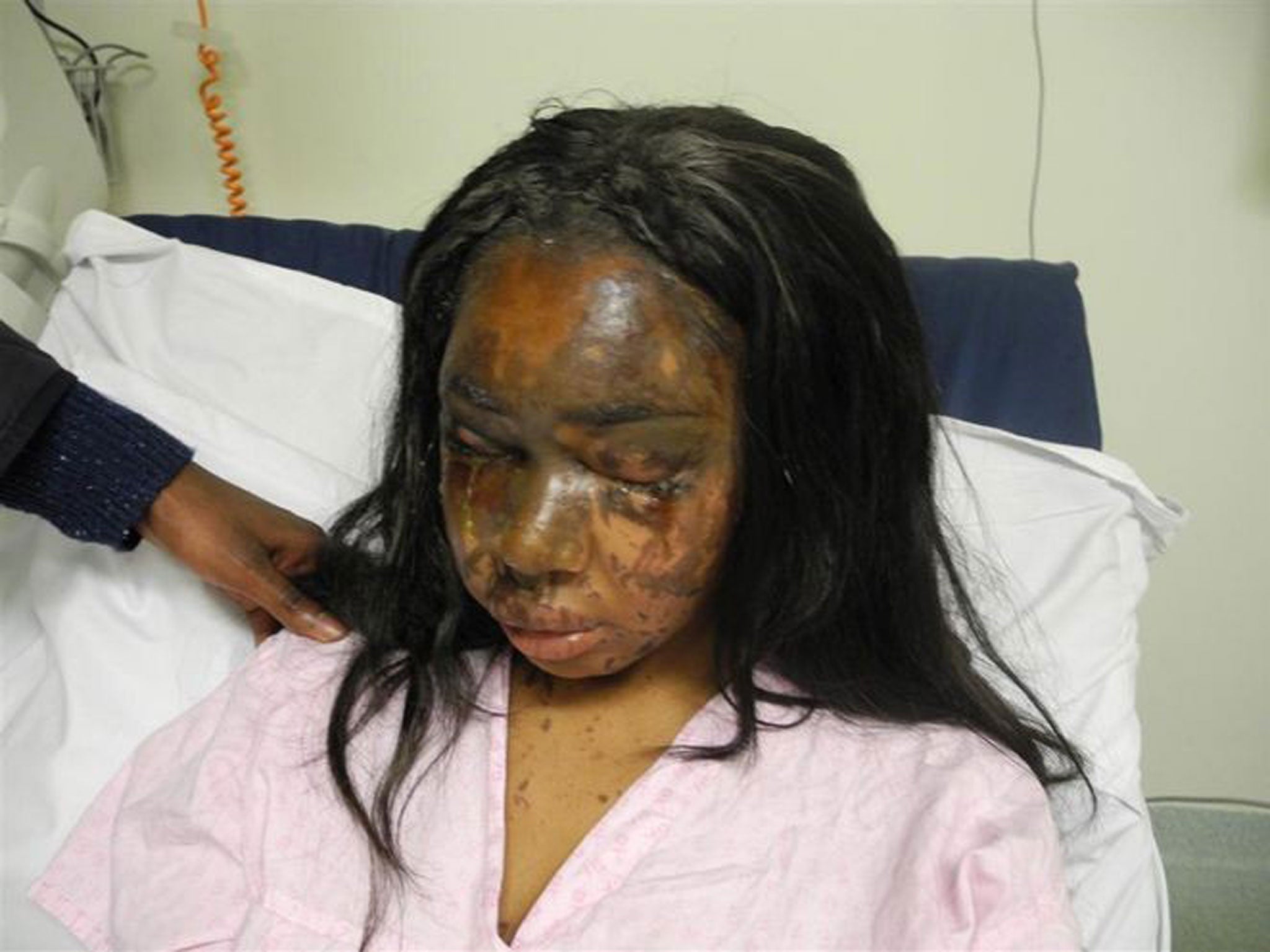 Naomi Oni was on her way home from work when acid was thrown in her face
