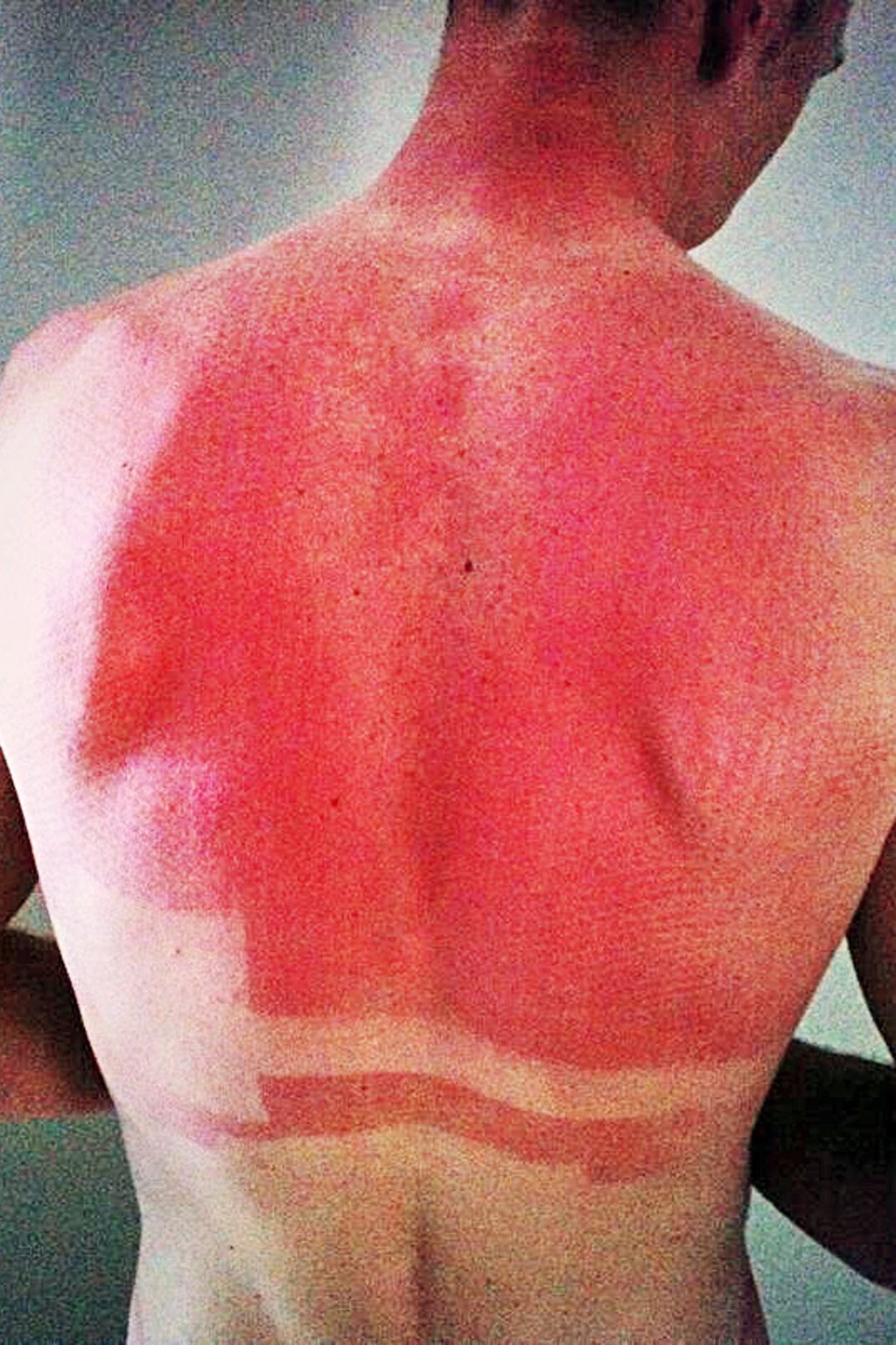 Chris Froome's sunburnt back