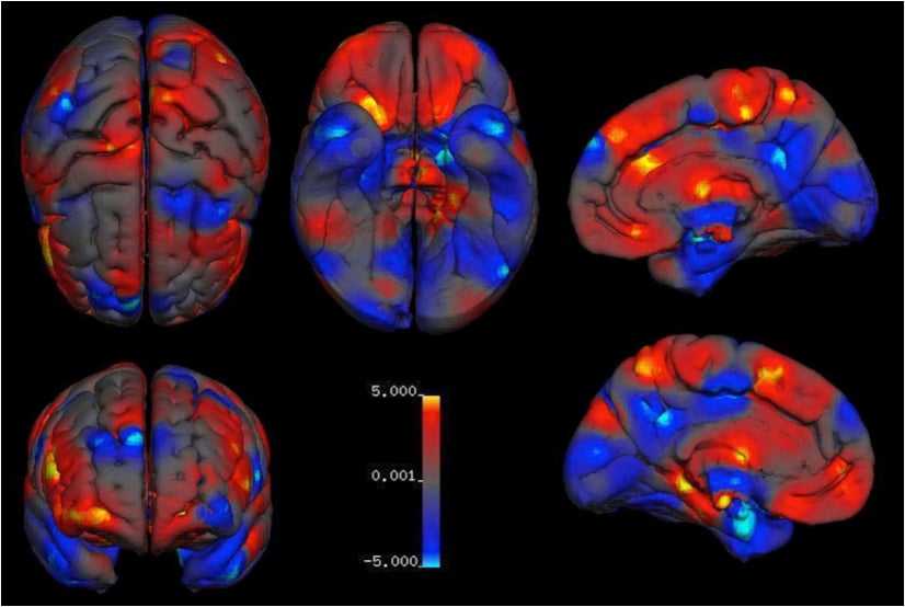 An overview of average regional sex differences in grey matter volume. Areas of larger volumes in women are in red and areas of larger volume in men are in blue.