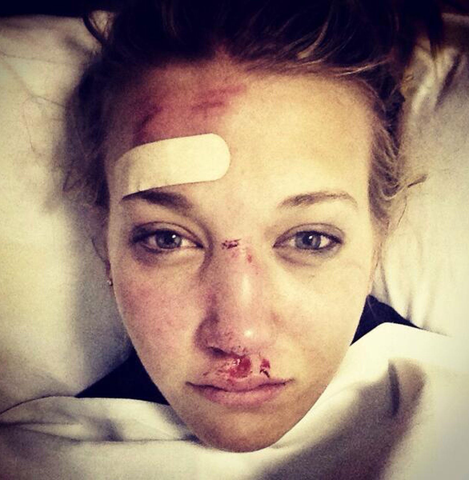 Rowan Cheshire posted this picture on Twitter showing the extent of her injuries from a skiing accident