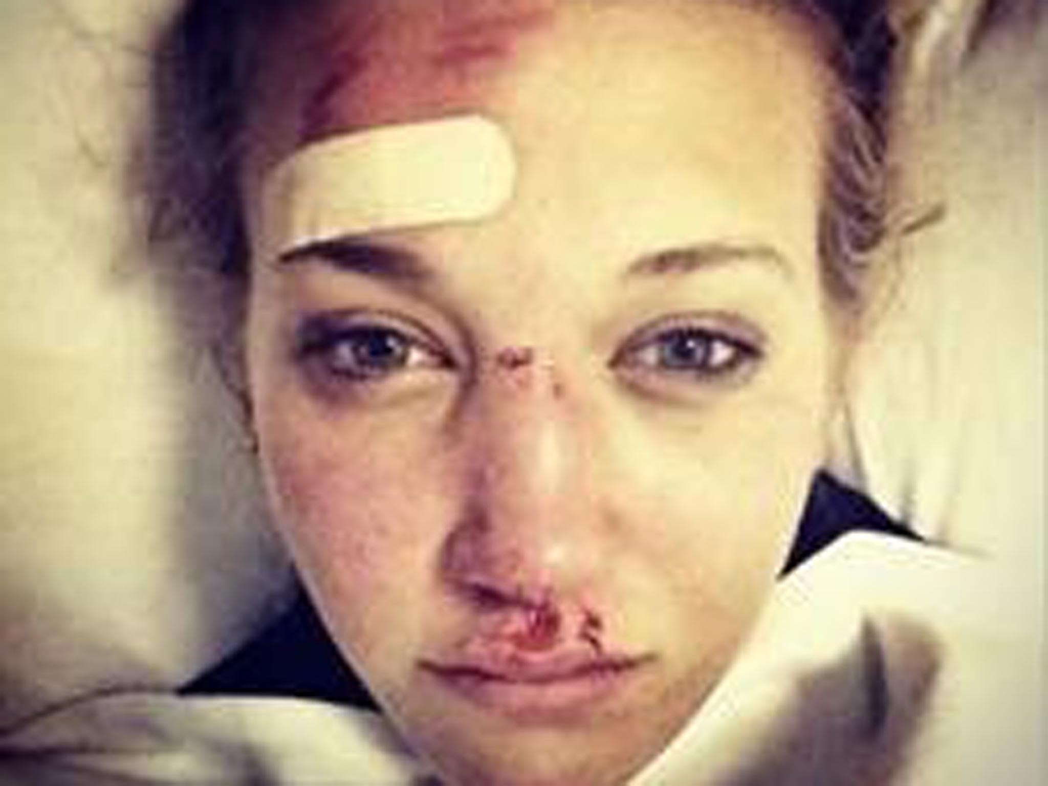 Rowan Cheshire posted this picture of her injuries on Twitter yesterday