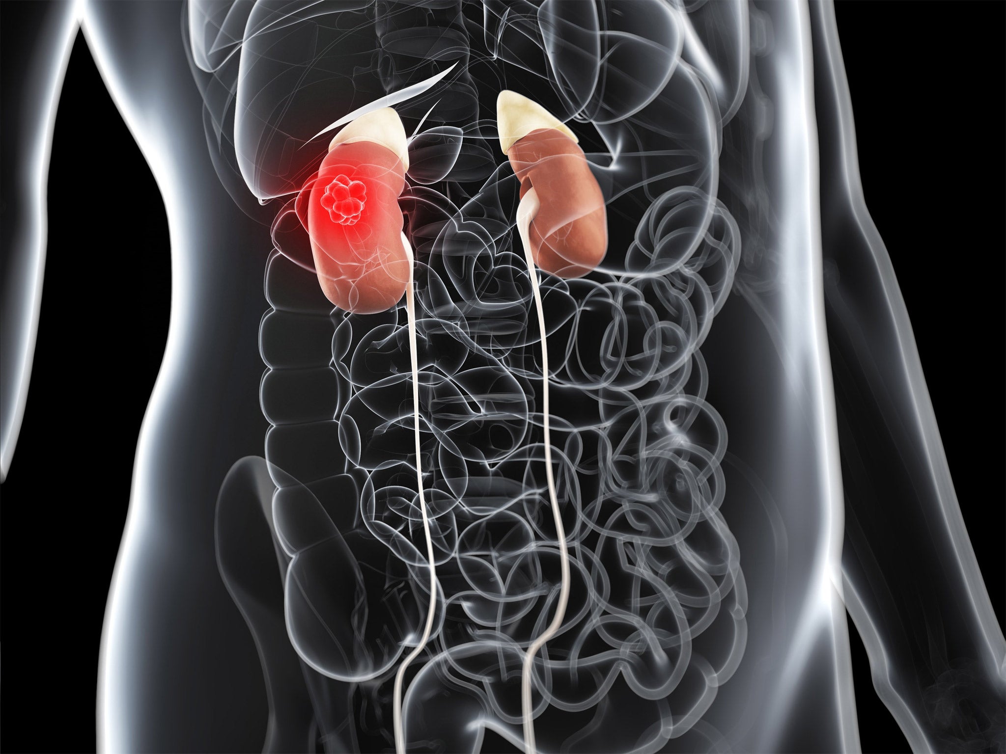 The kidneys filter toxic chemicals from the body and may become cancerous from a diet high in carcinogenic chemicals