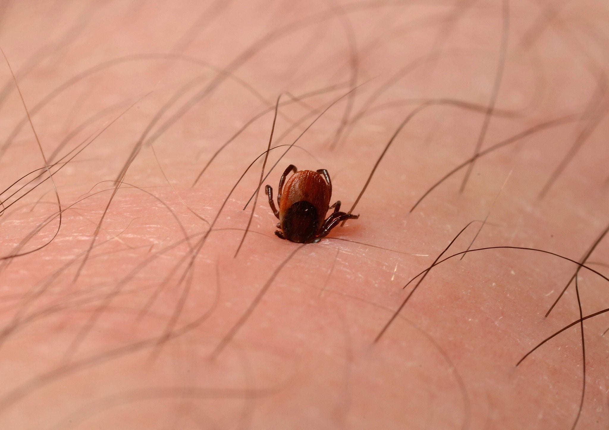 Deer tick embedded in skin of leg. A tick (Ixodes Ricinus) attached to the leg of a man