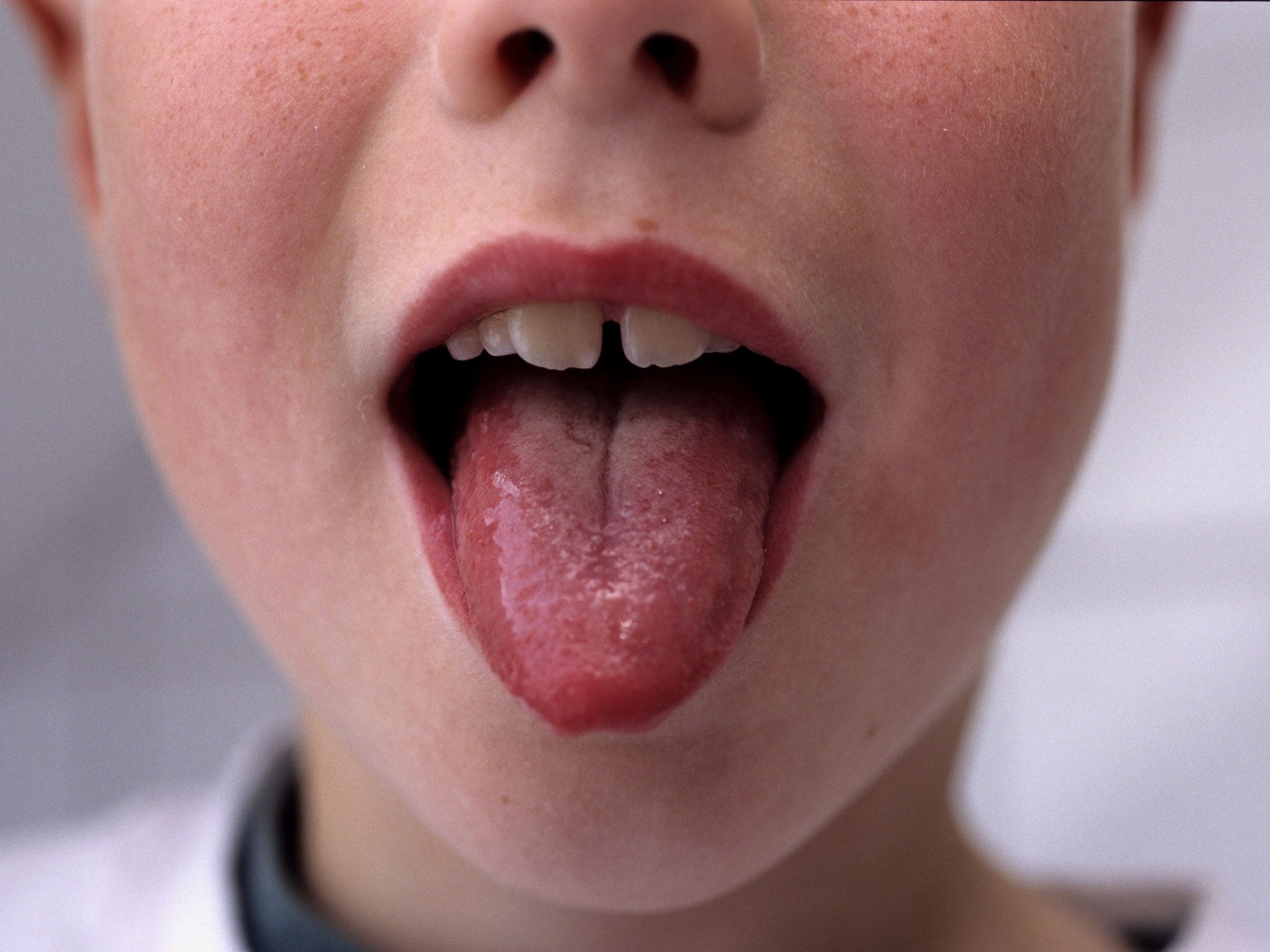 A swollen tongue can be a symptom on top of the pink-red rash