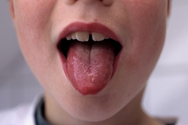 A swollen tongue can be a symptom on top of the pink-red rash