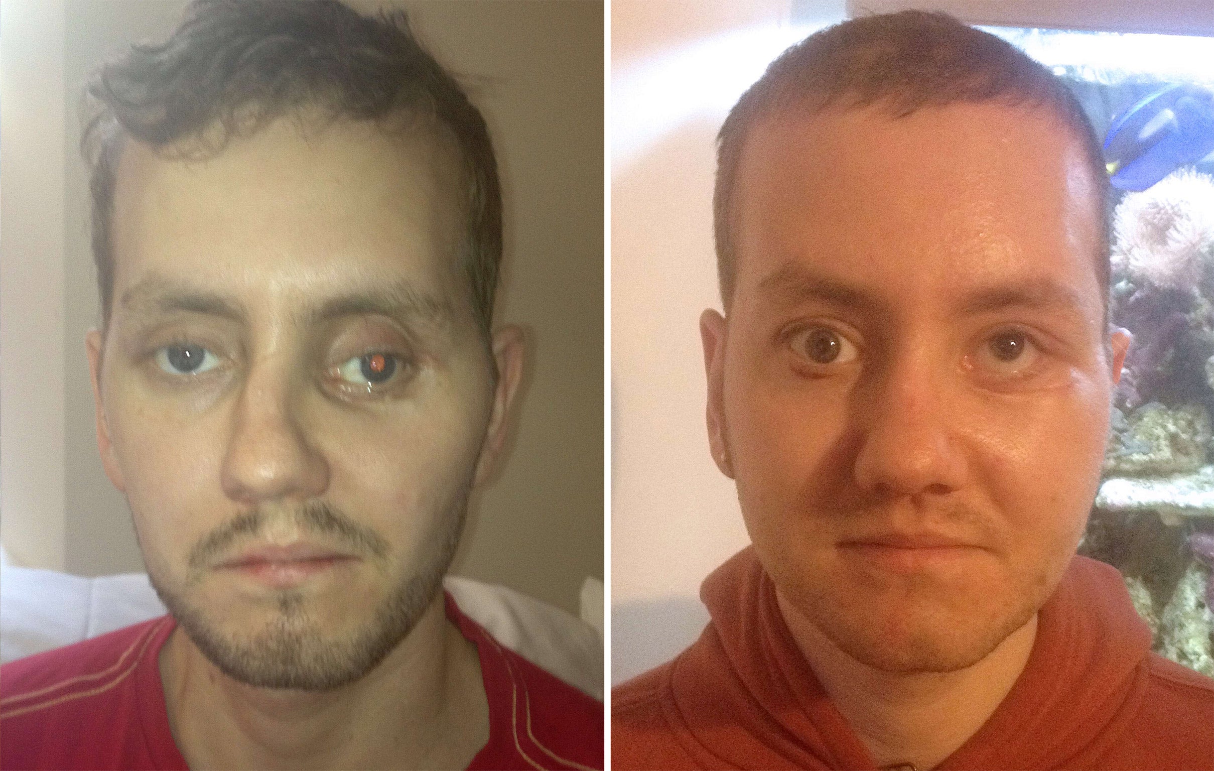 Stephen Power before having facial reconstruction surgery (left) in Wales following a motorcycle accident and after the surgery (right)