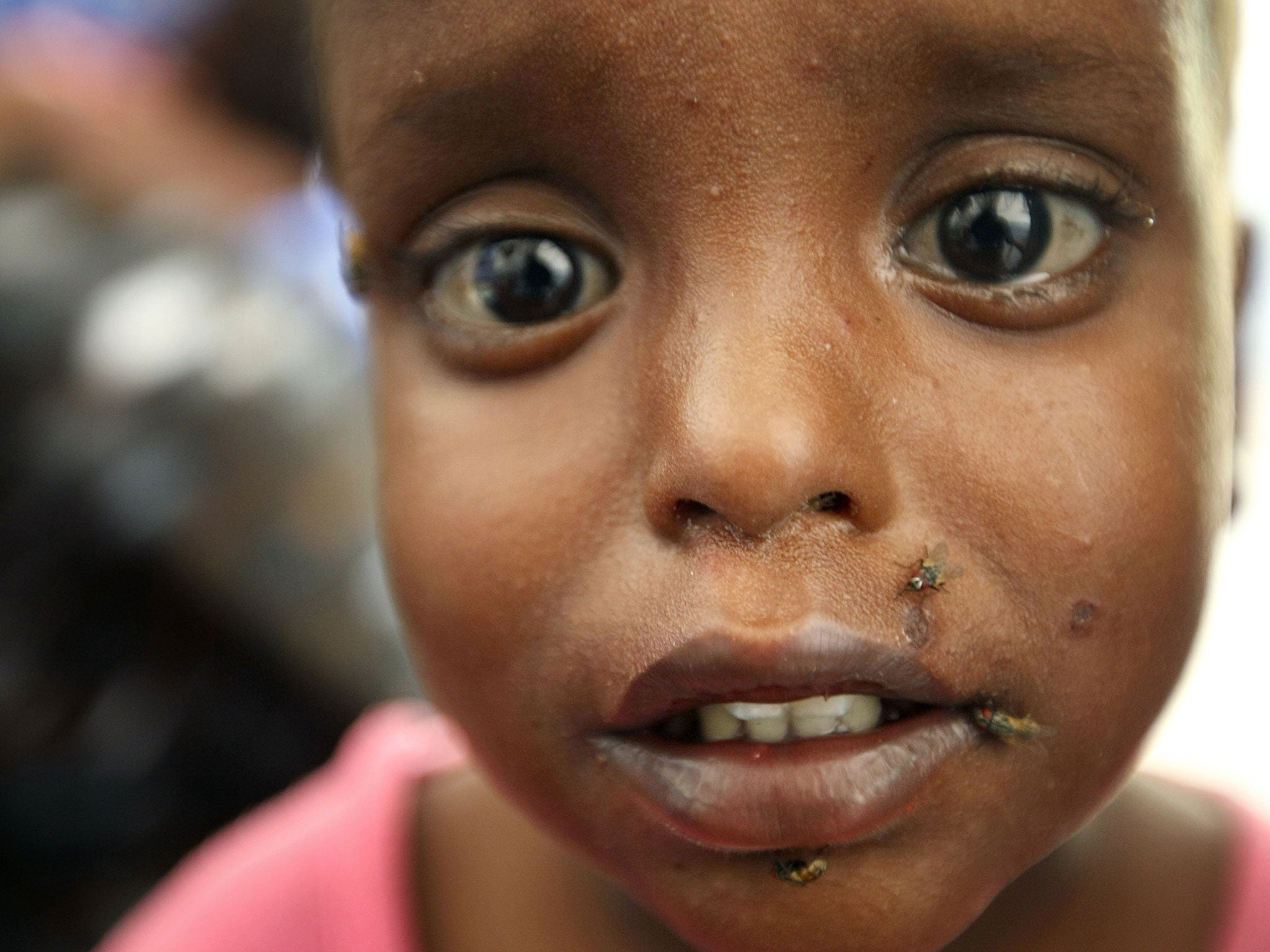A child suffering from malnutrition and diarrhoea is seen at the Banadir hospital in the Somalian capital of Mogadishu in 2009. Climate change will lead to increases in ill-health in many regions, with examples including an increased likelihood of under-nutrition.