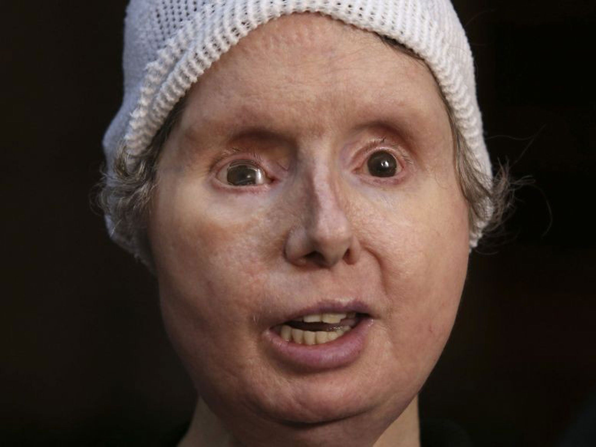 woman face transplant after chimpanzee attack