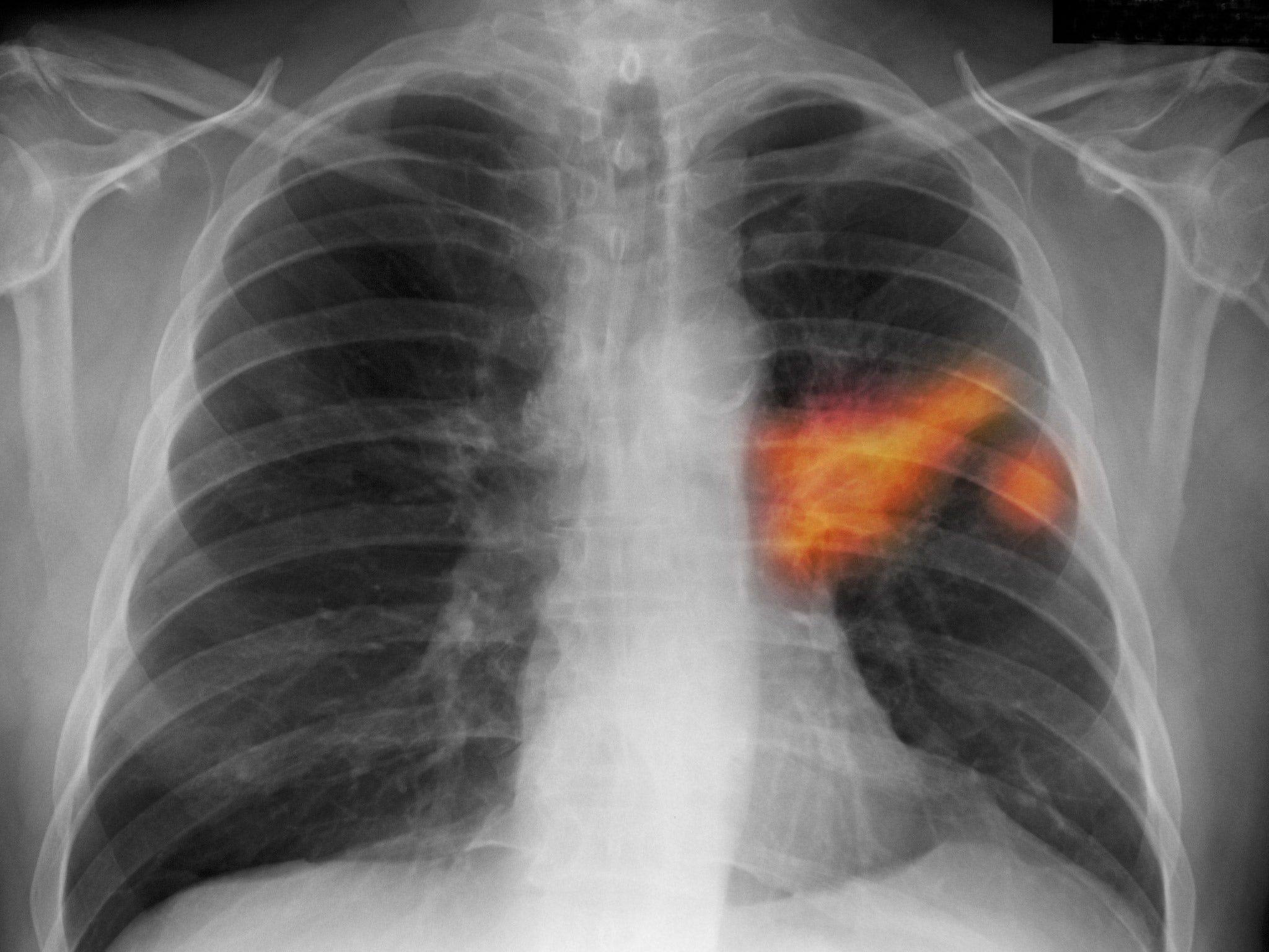 X-ray of a lung cancer sufferer (Kallista Images/Getty)