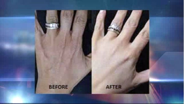 A before and after shot showing the effects of a 'hand lift' (and some judicious lighting). Credit: Pix11