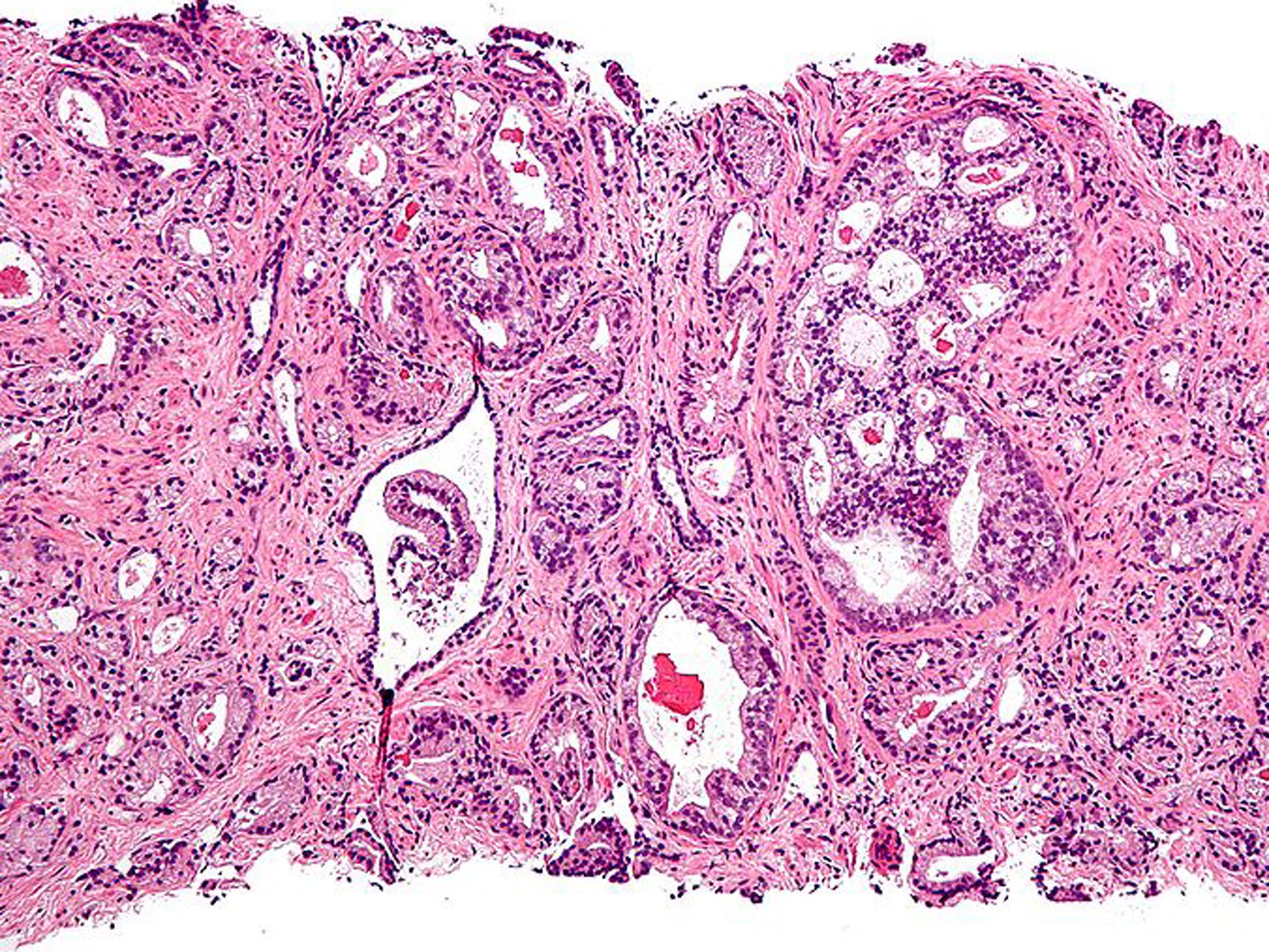 Prostatic acinar adenocarcinoma, the most common form of prostate cancer