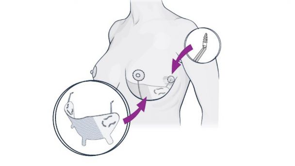 New plastic surgery installs 'internal bra' under the skin for