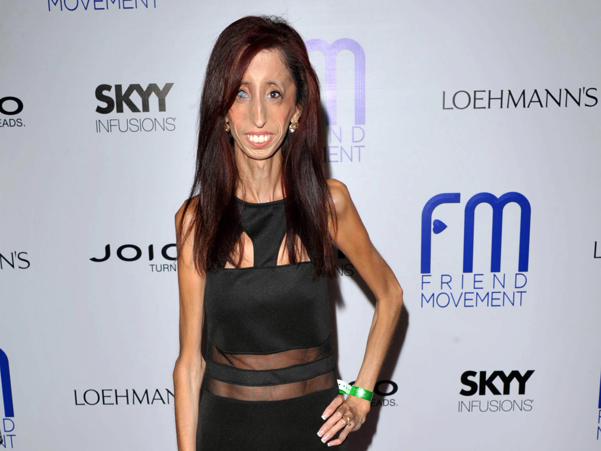 Lizzie Velasquez, who possesses a rare and unknown syndrome that prevents her from gaining weight. She is raising funds on Kickstarter for an anti-bulling documentary