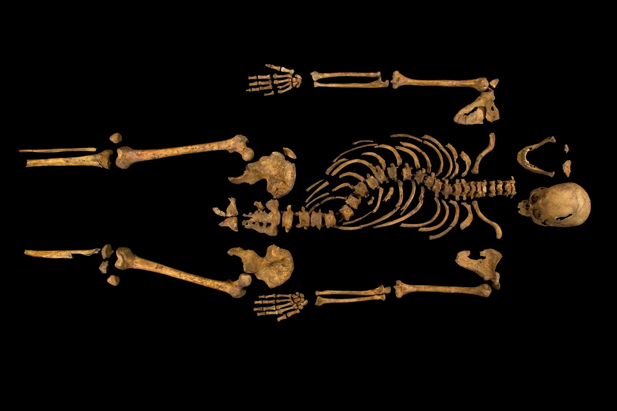 Richard III ’s remains show his scoliosis