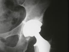 Hip replacement operations more popular than iPhones, according to NHS