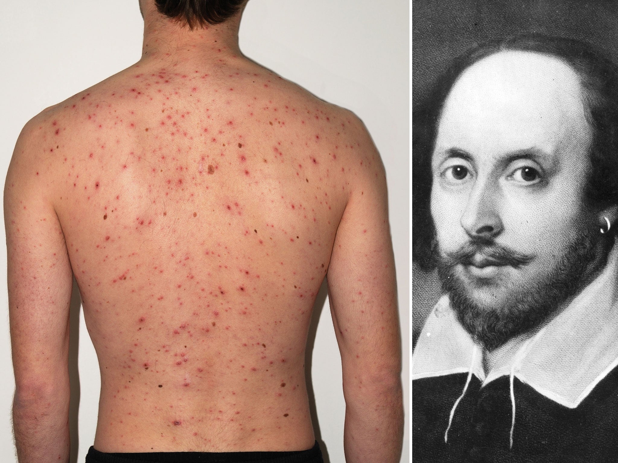 Medical experts are claiming that Shakespeare’s success has resulted in a painful legacy for people will skin disease