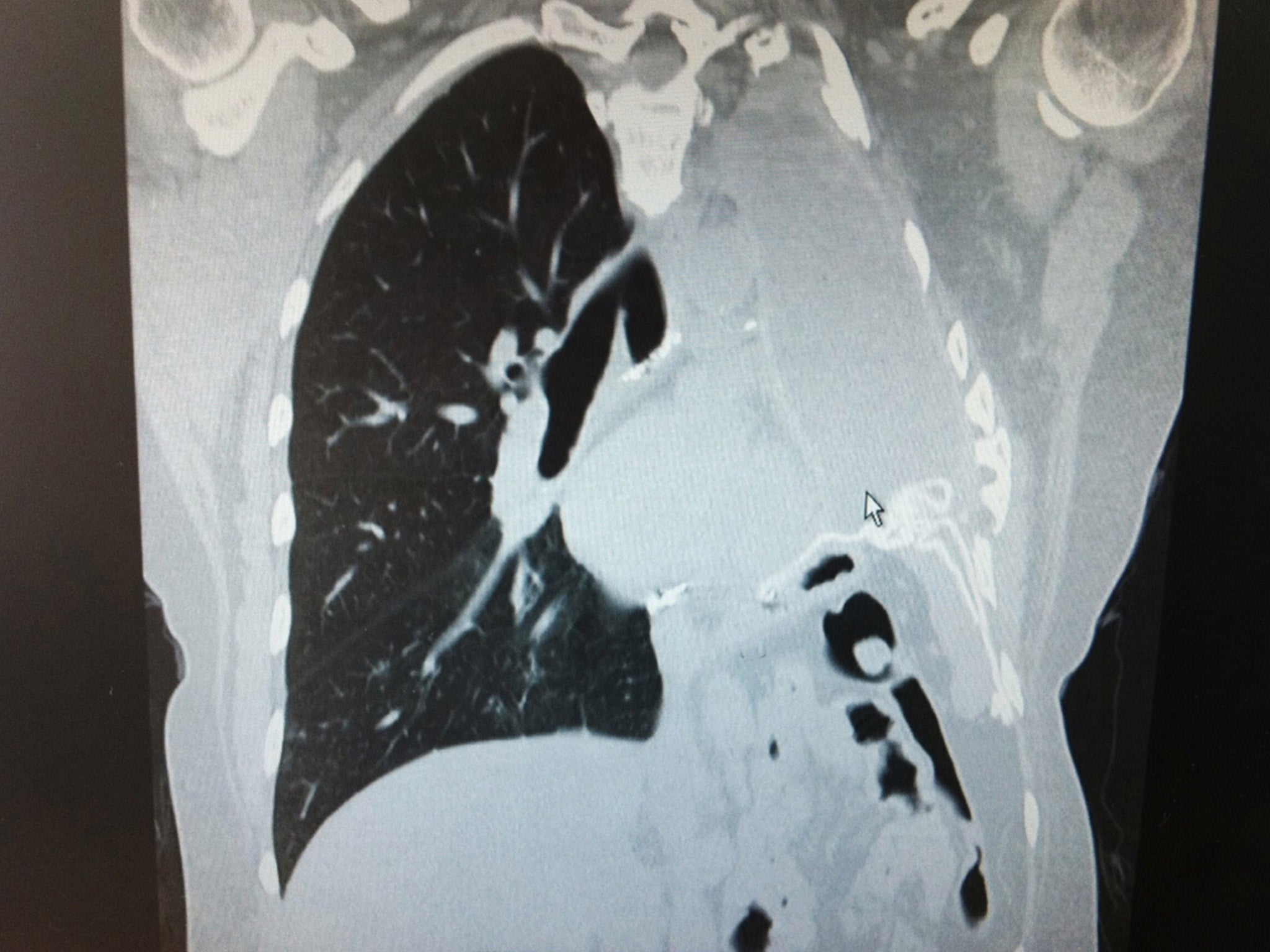 X-ray shows the missing left lung of a mesothelioma cancer sufferer