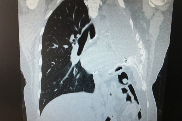X-ray shows the missing left lung of a mesothelioma cancer sufferer