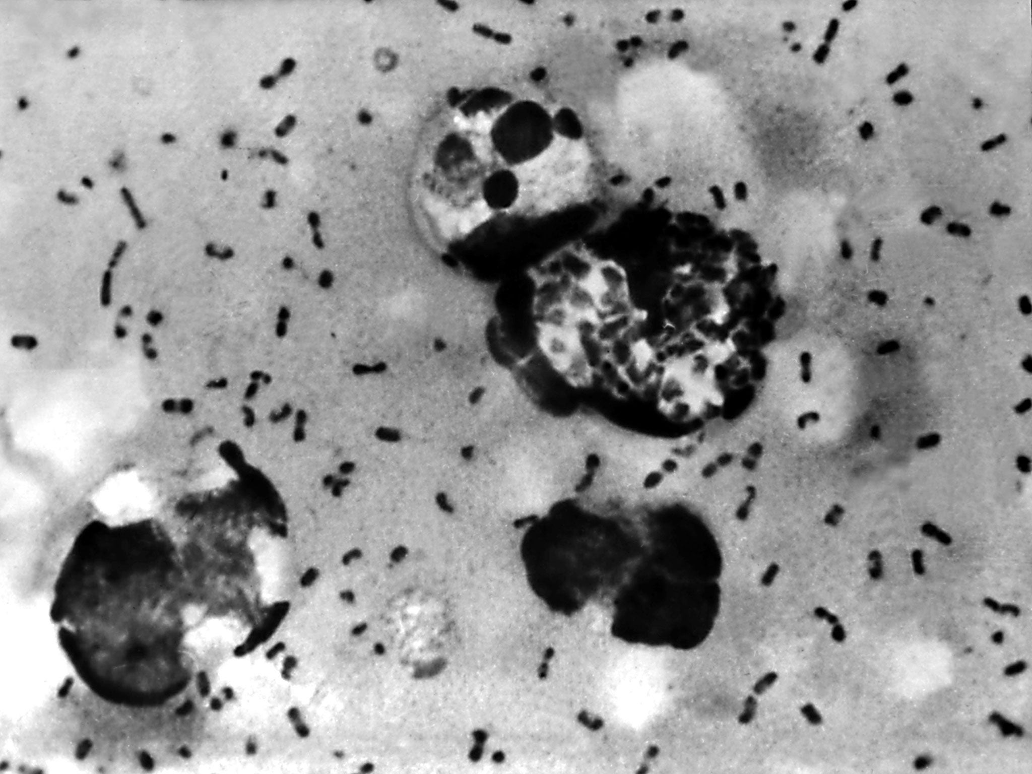 A bubonic plague smear, prepared from a lymph removed from an adenopathic lymph node, or bubo, of a plague patient