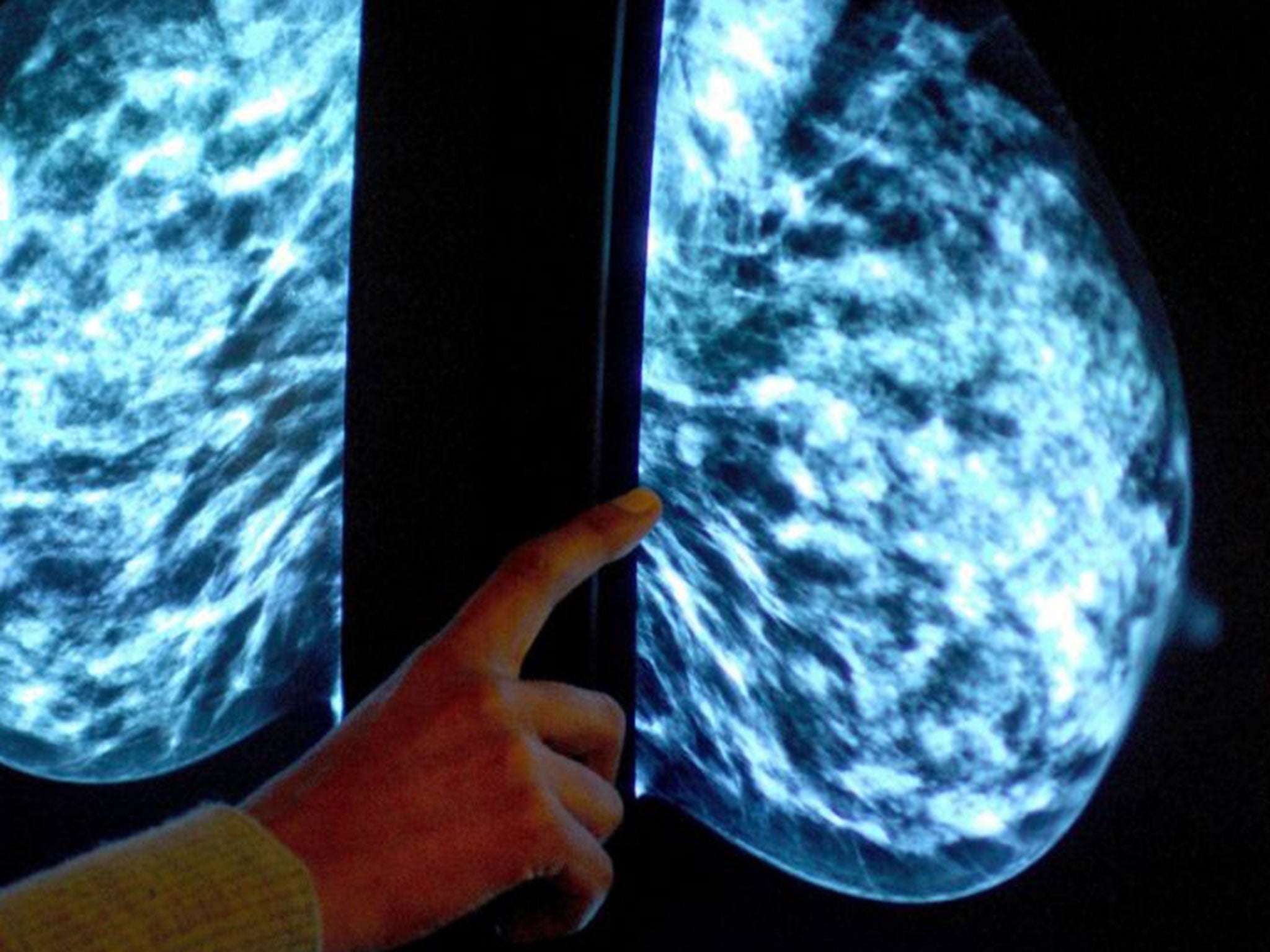 File photo of a mammogram. Tens of thousands of people diagnosed with breast cancer could benefit from an "innovative" new type of radiotherapy delivered during surgery instead of through a traditional course of treatment.