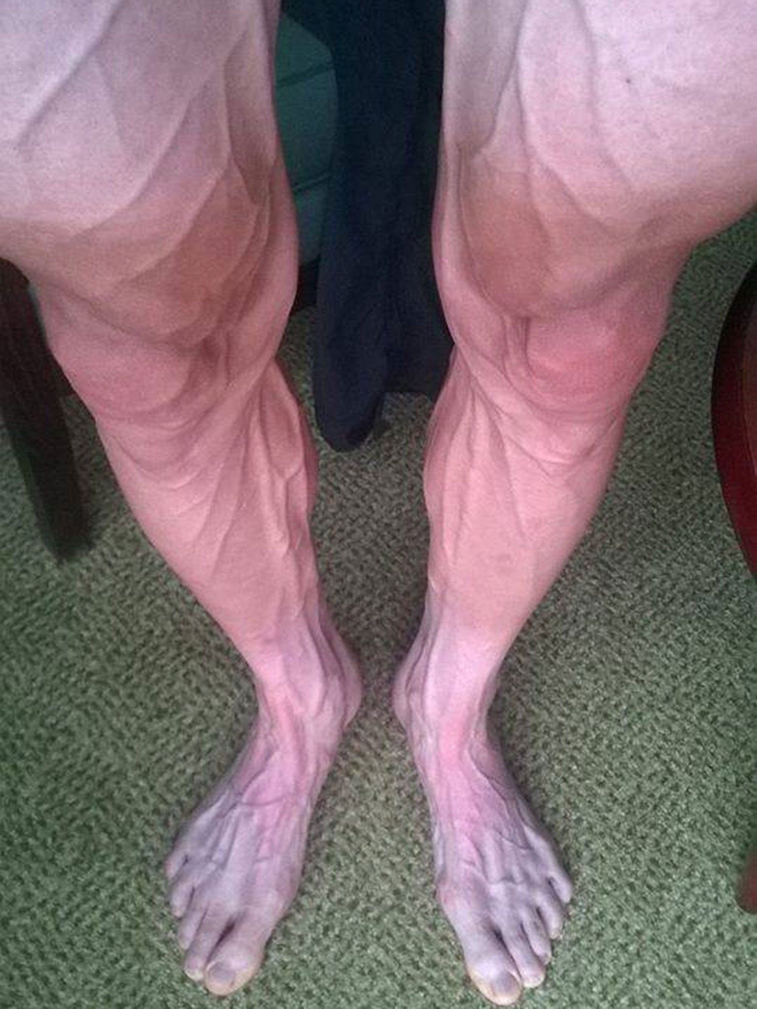 Tour de France competitor Bartosz Huzarski’s legs have highlighted the gruelling nature of the race, after he posted a picture on Facebook showing extremely prominent veins stretching from his feet and all the way up his legs.