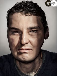 Man who had whole face transplantafter becomes GQ star