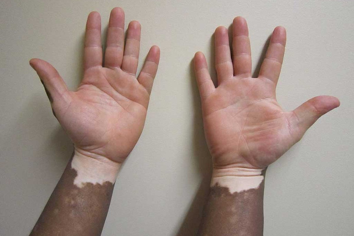 melanotic whitlow Herpetic Living with vitiligo: so what
