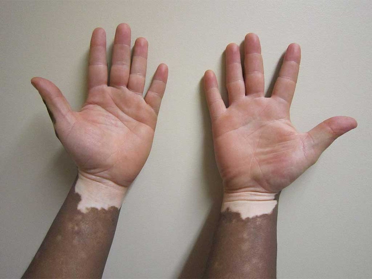 melanotic whitlow pictures Herpetic Whitlow Condition, Treatments and Pictures for Adults main image 1
