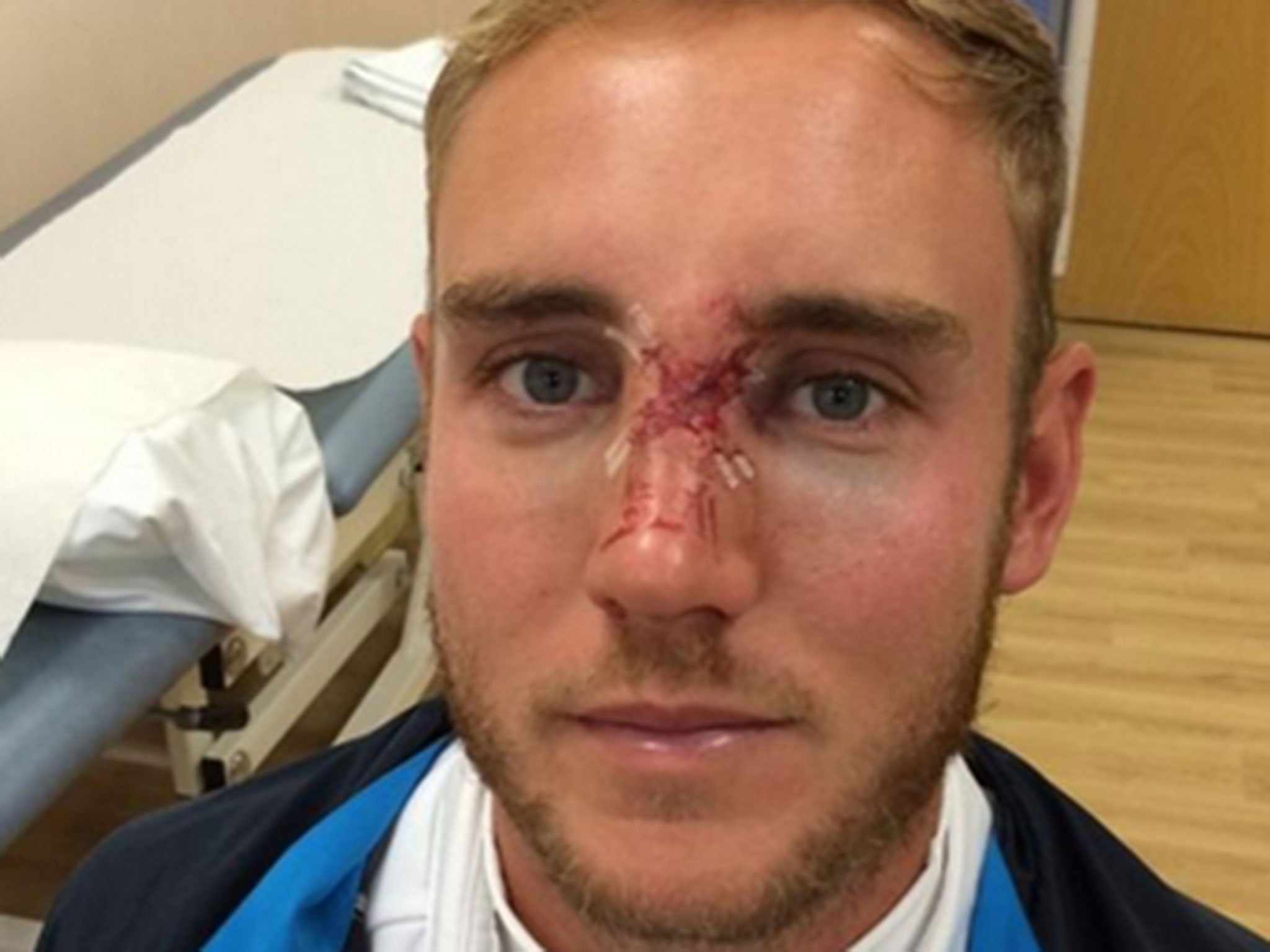 Stuart Broad shows his fractured nose