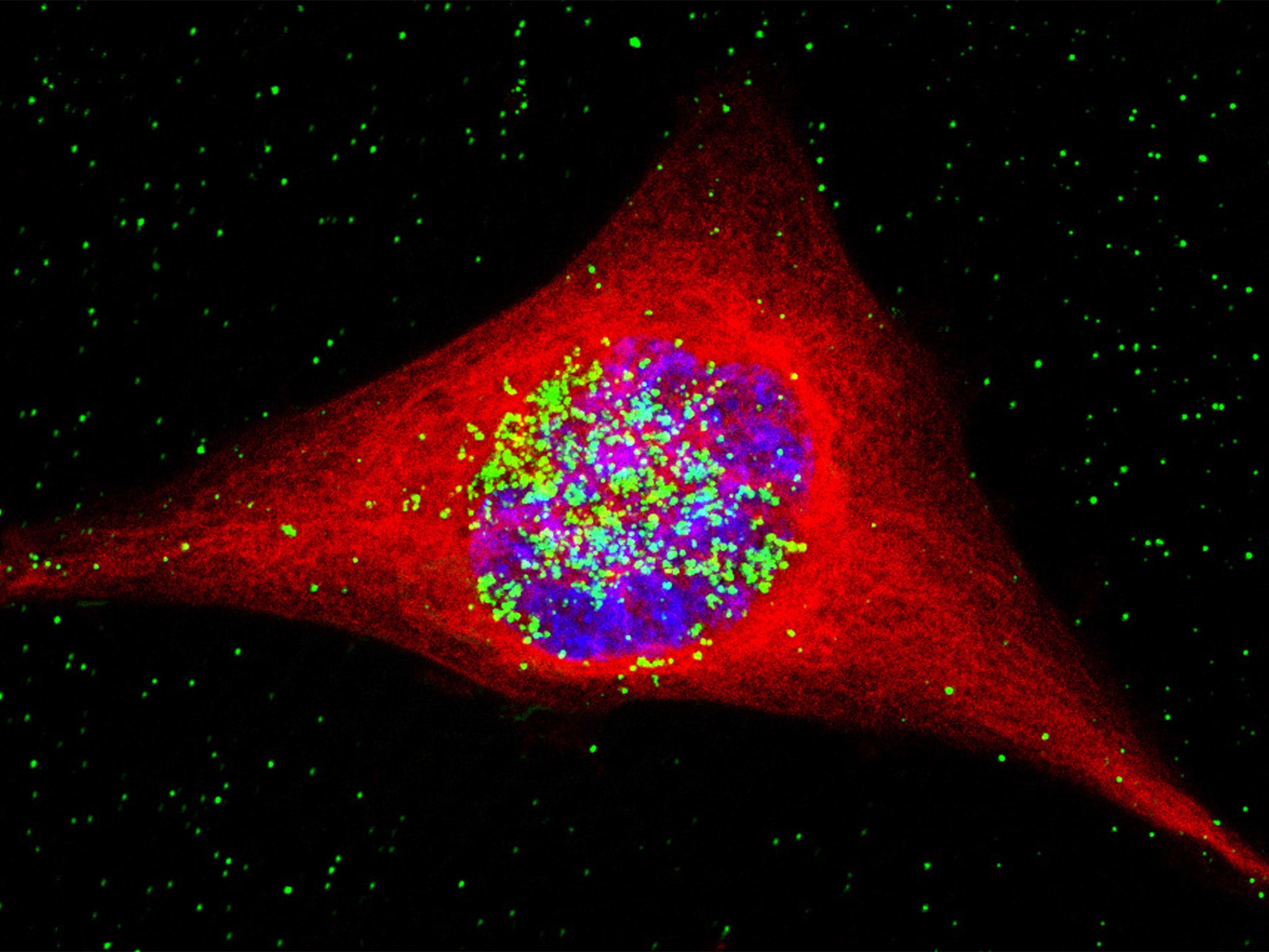 A cancer cell containing nanoparticles of gold (coloured green) in the nucleus (blue)