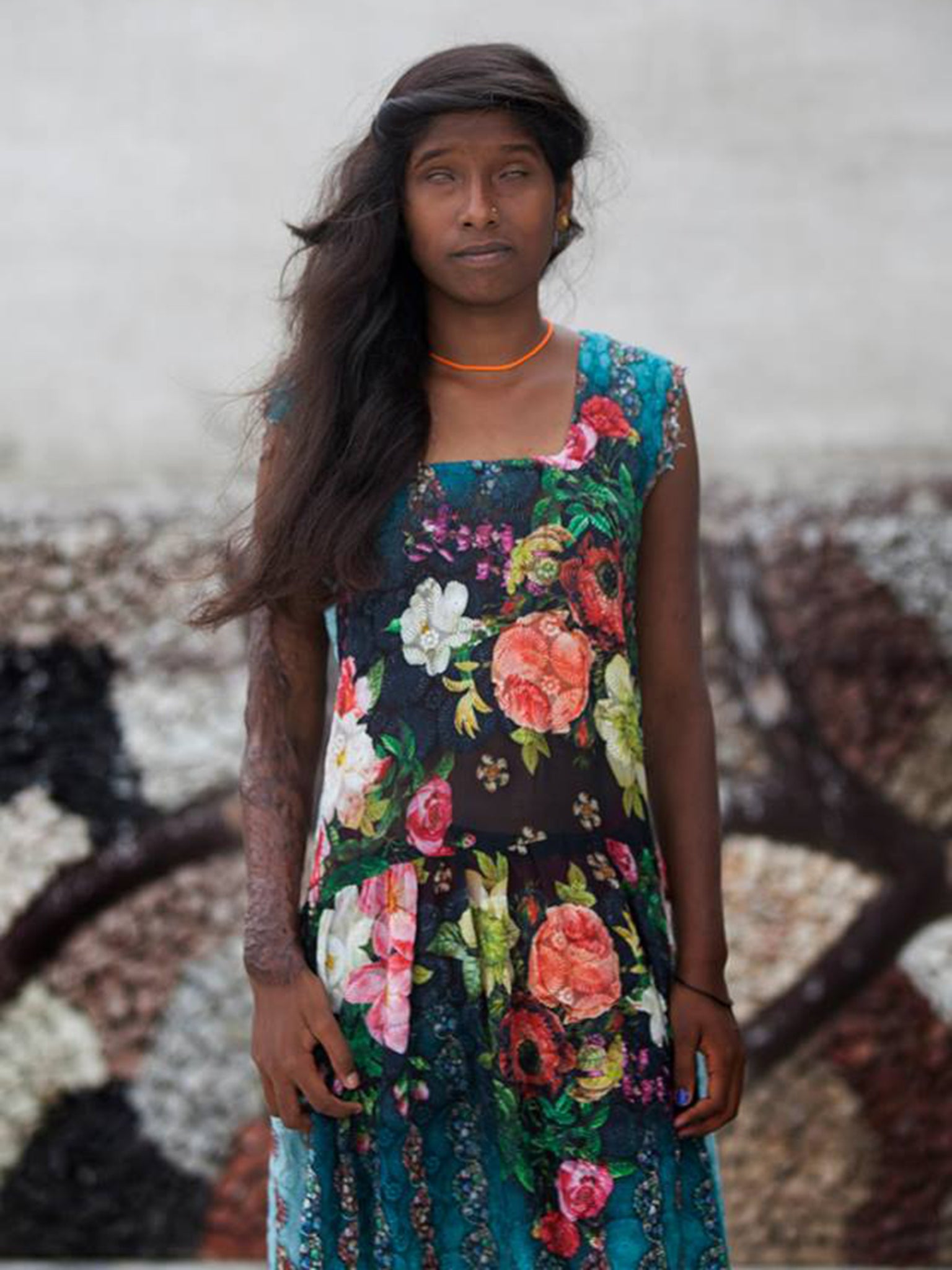 Southampton acid attack victim Carla Whitlock reveals she could lose ...
