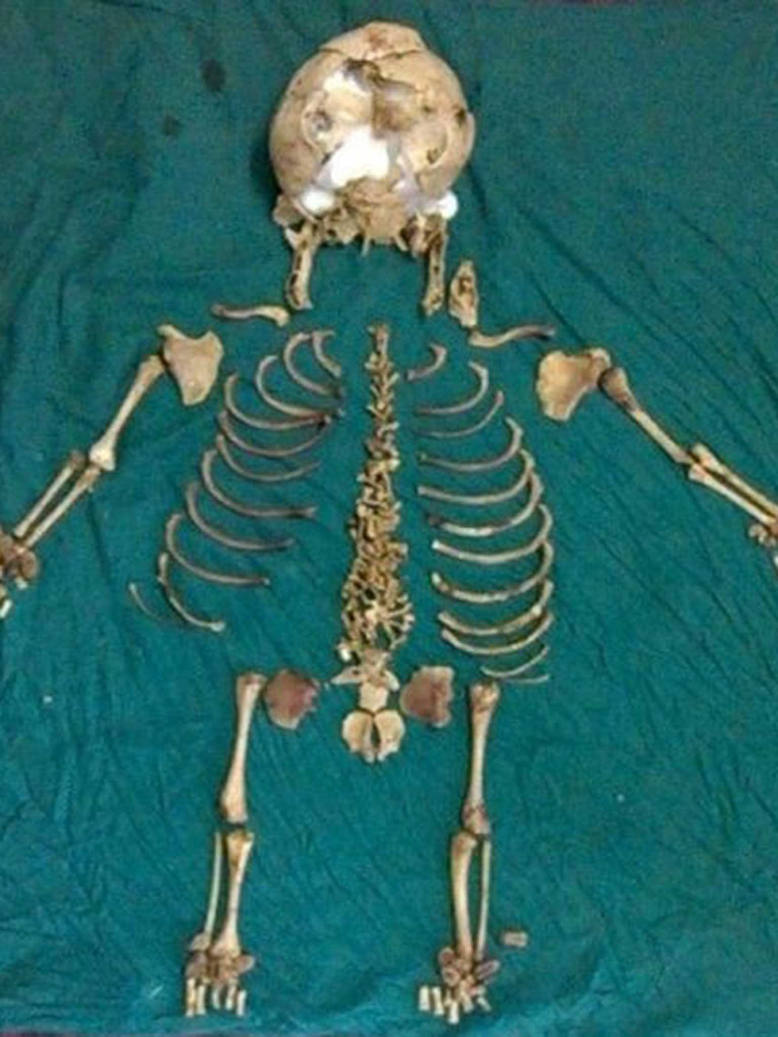 36-year-old skeleton of dead baby found inside Indian woman, The  Independent