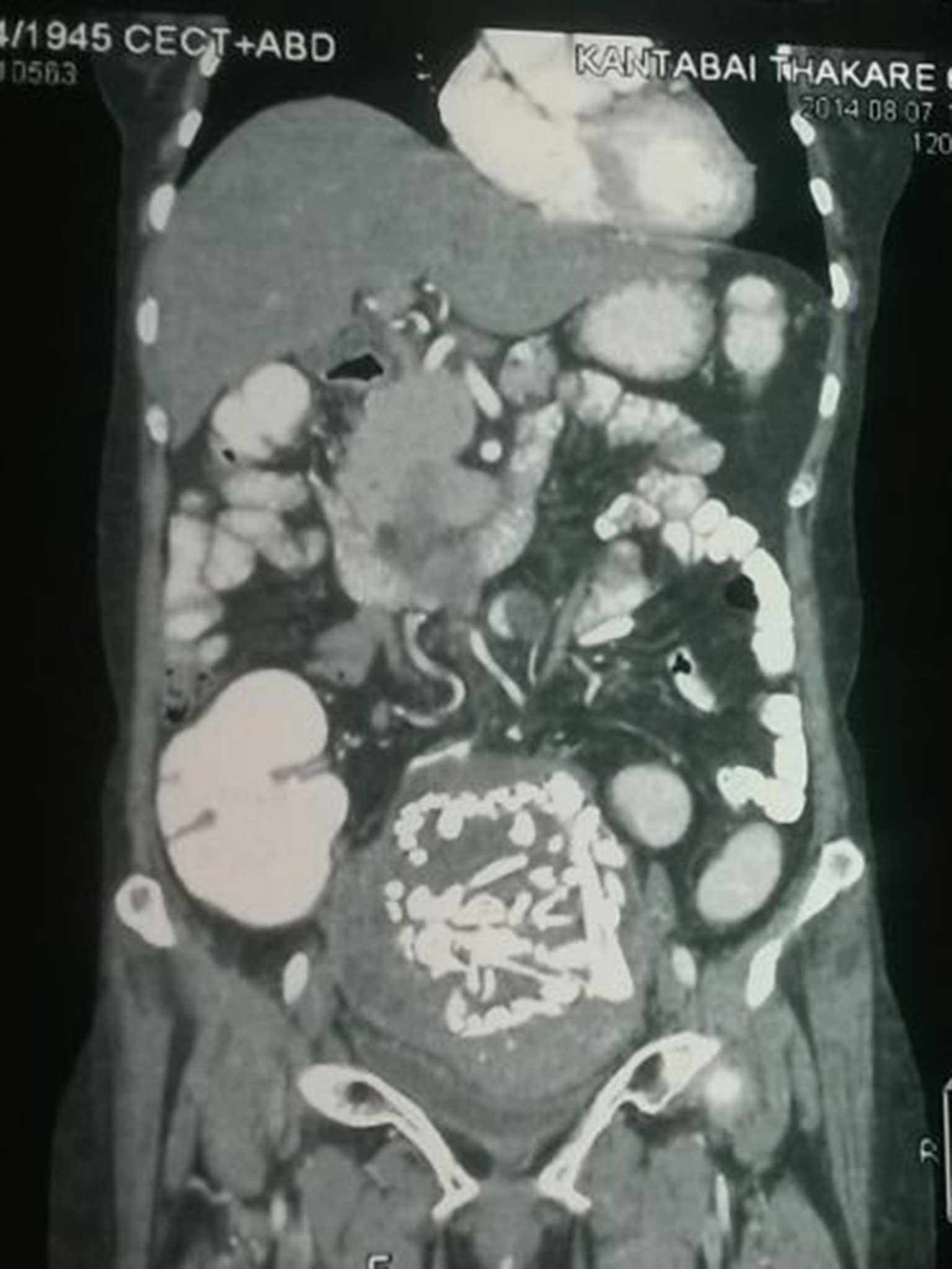 The CT scan of the mass containing the bones of a dead foetus