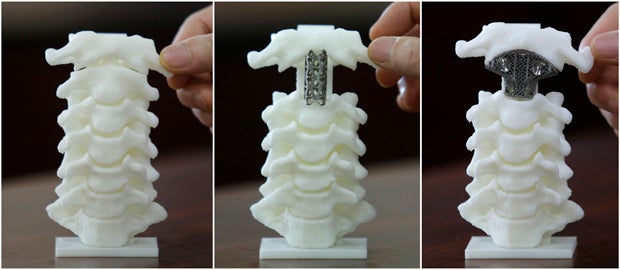 The 3D-printed vertebra on the far right, and the traditional aluminium support tube in the middle. Image: Reuters