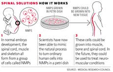 Breakthrough in spinal cord research could lead to eventual motor neurone disease cure