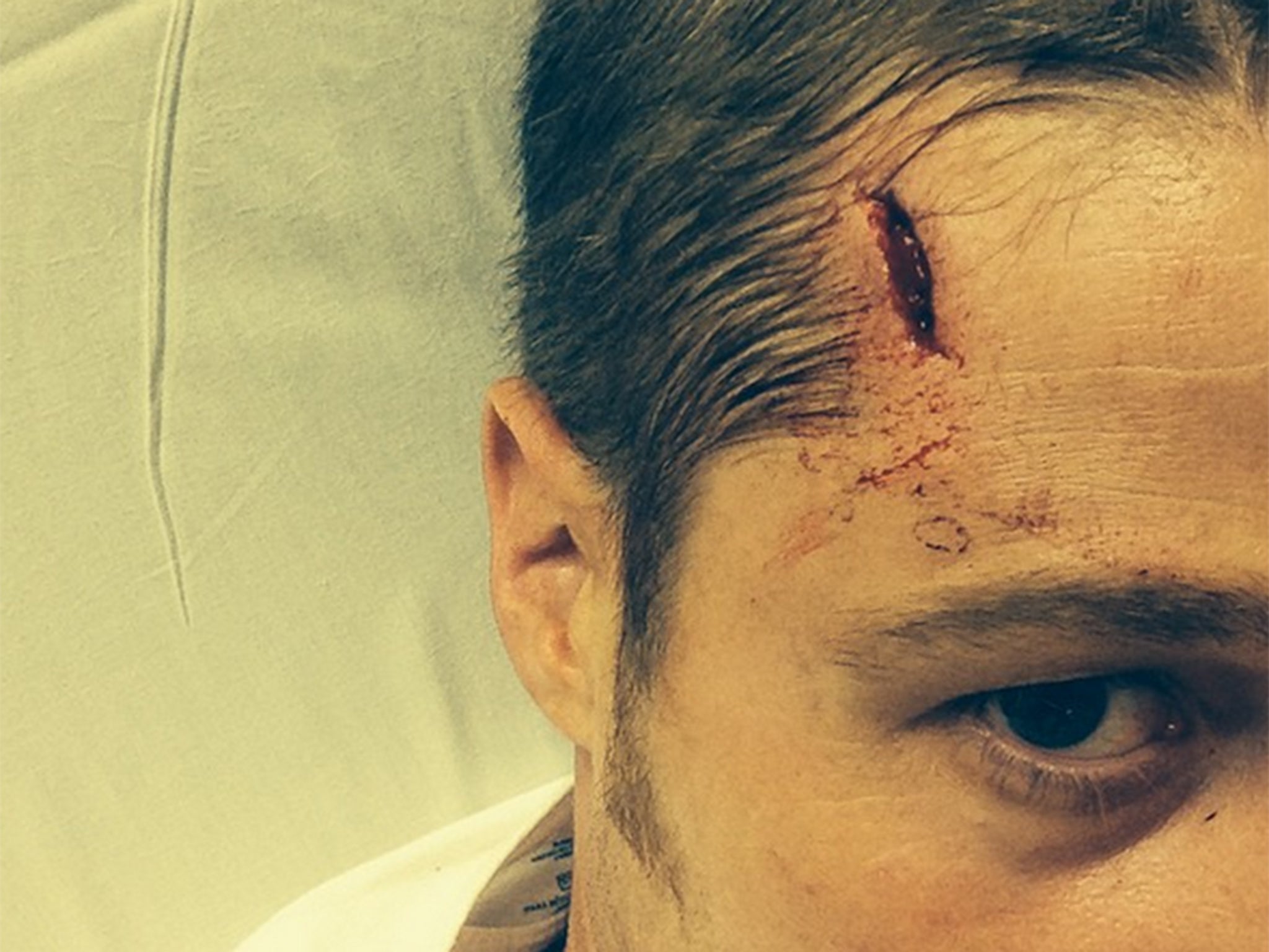 Ben McKenzie shared an image of the injury on social media