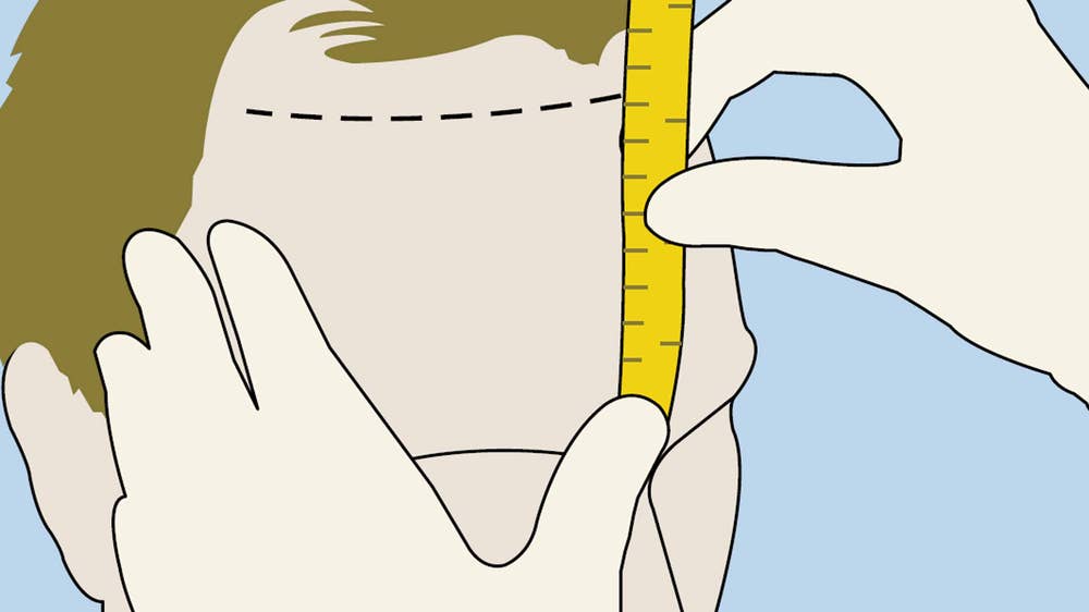 Hair transplant: The method