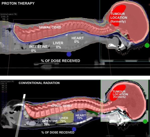 A graphic by the Proton Therapy Centre comparing the alternative treatment with conventional radiotherapy